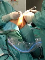 Ortopedi říčanské nemocnice operují chrupavku novou metodou